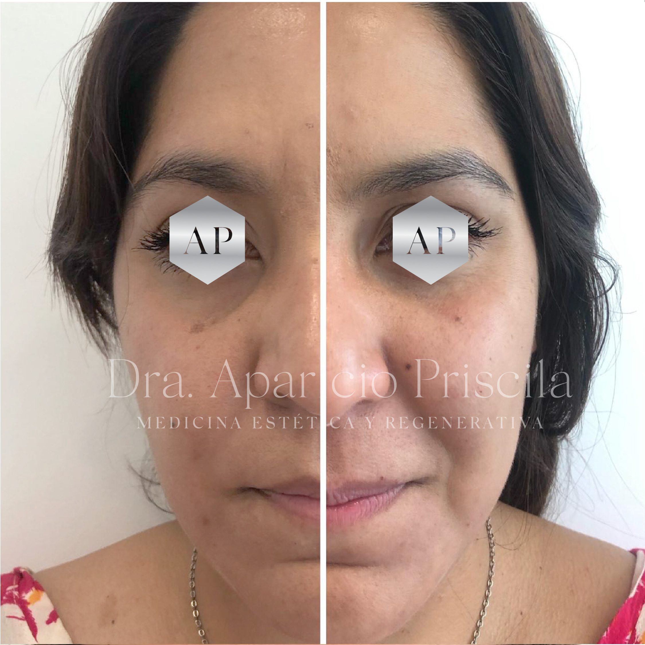 Caso de Uso de Ojeras