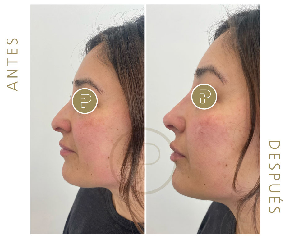 Caso de Uso de Armonización Facial con Ácido Hialurónico