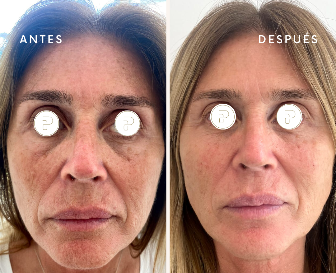 Caso de Uso de Long Lasting
