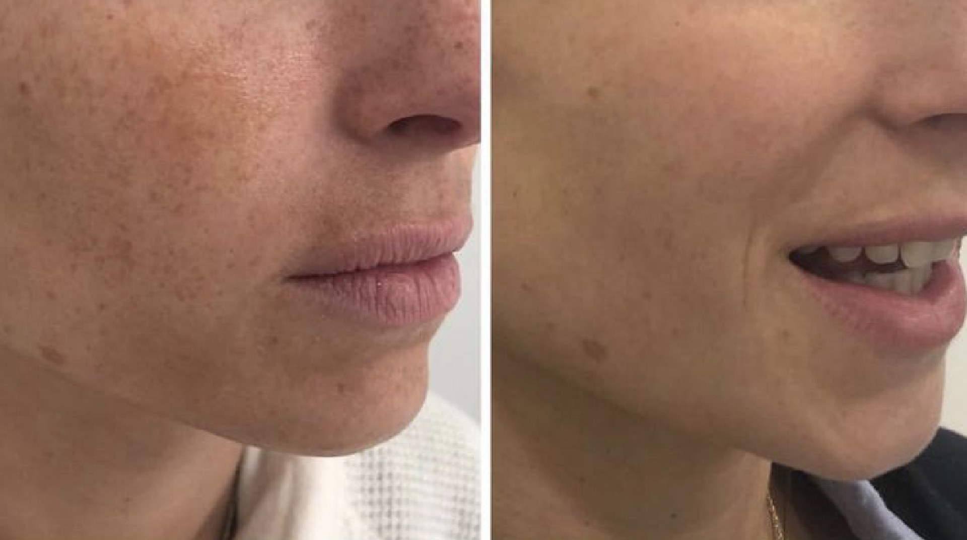 Caso de Uso de Peeling Químico