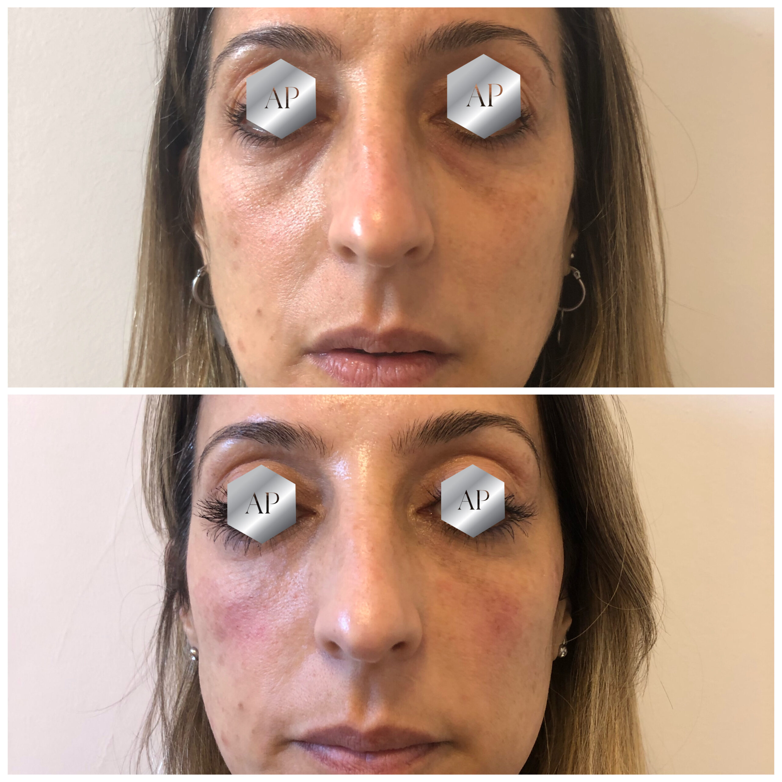Caso de Uso de Ojeras