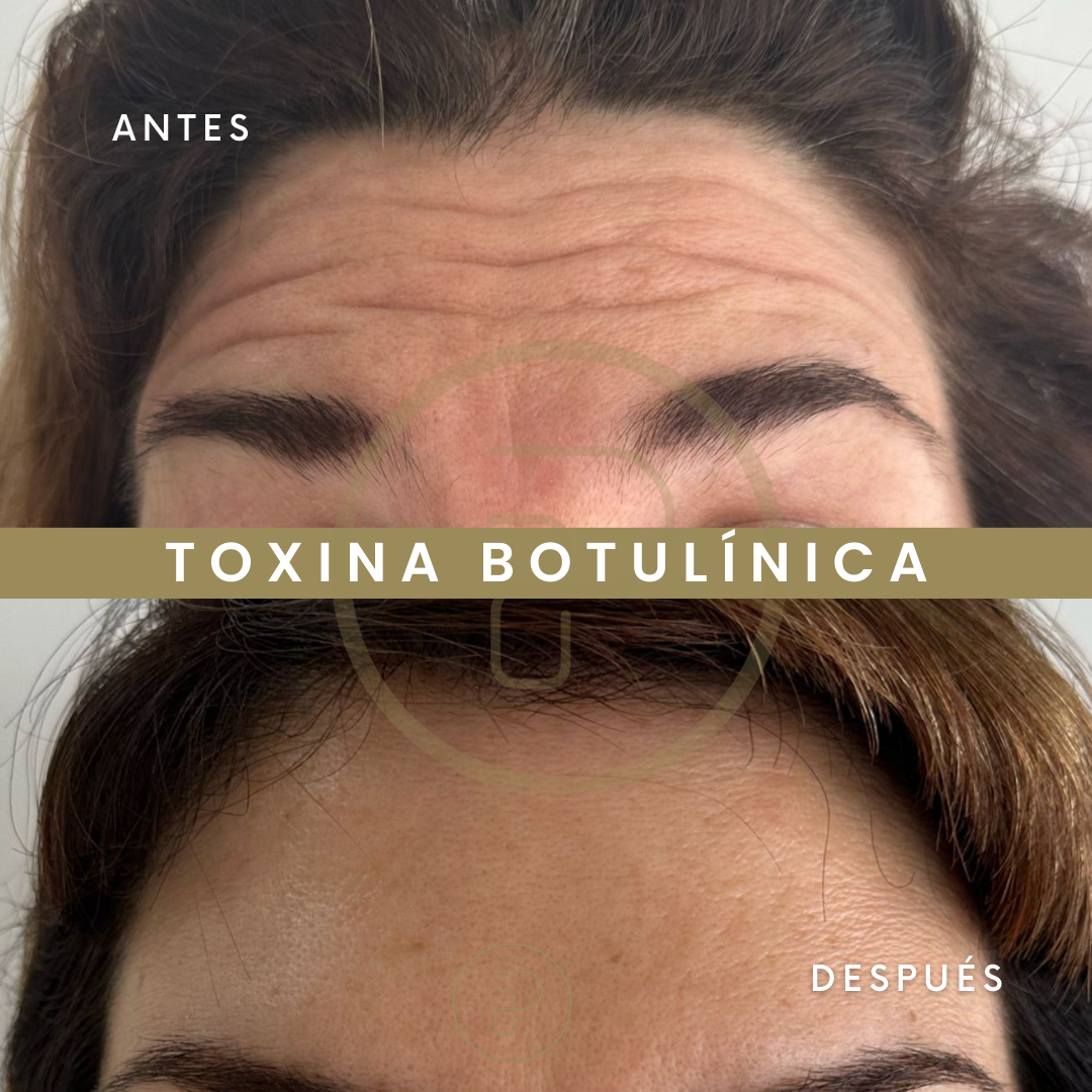 Caso de Uso de Prevención de Arrugas con Toxina Botulínica