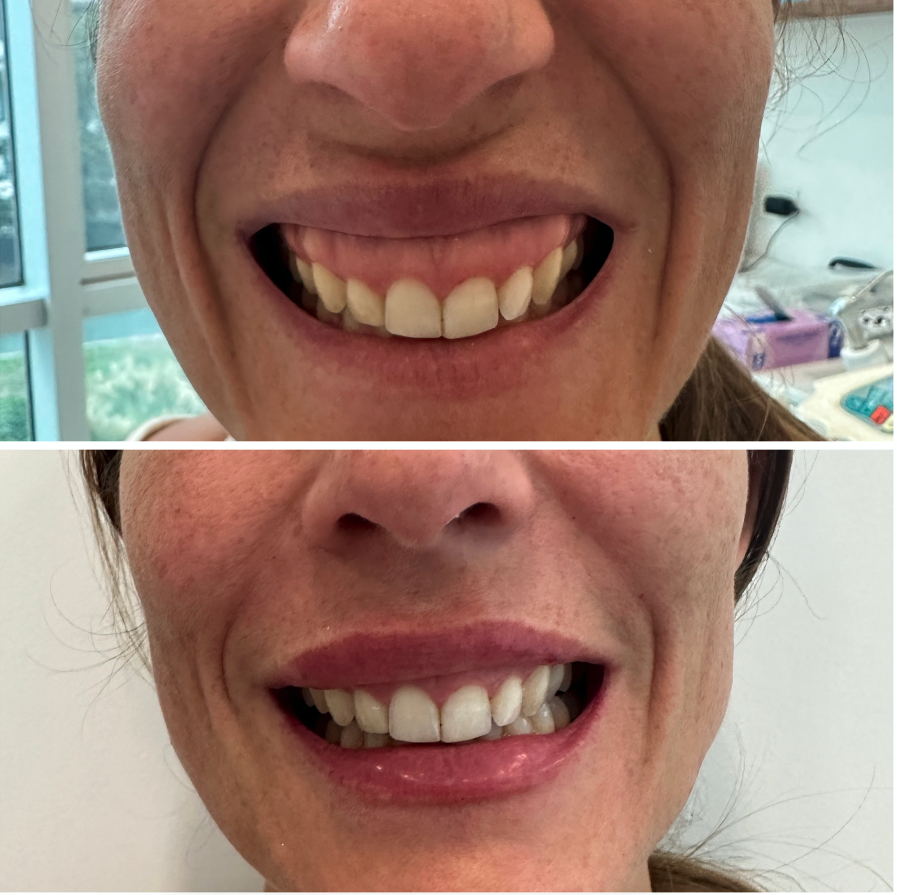 Caso de Uso de Sonrisa Gingival