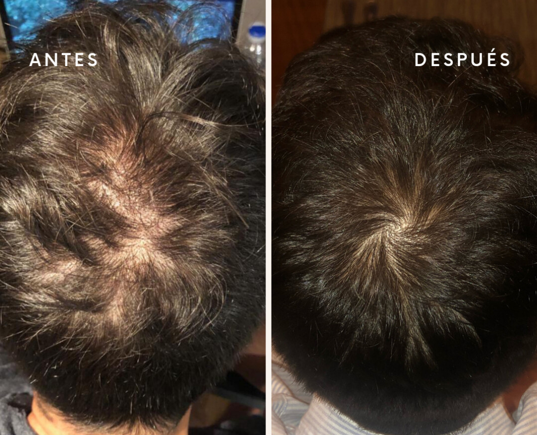 Caso de Uso de Plasma Rico en Plaquetas (Capilar)