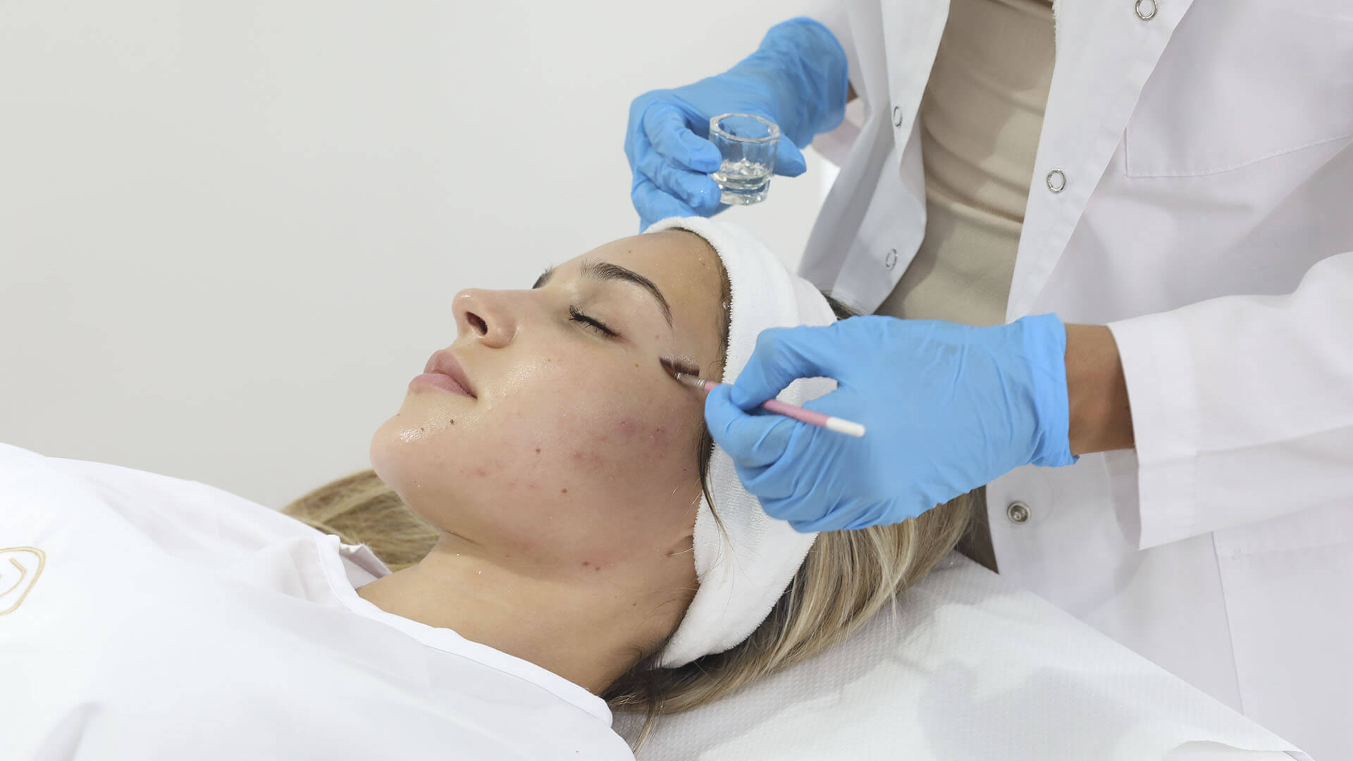 Peeling Químico